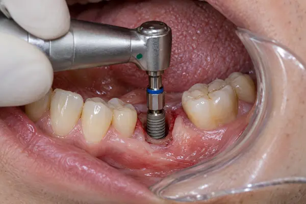 dentalna-implantatsiia-i-katehorii-1